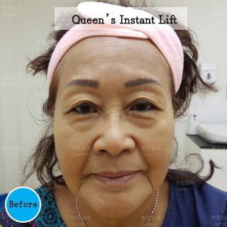 Instant-Lift-Before-Aunty-Helen Instant-Lift-Before-Aunty-Helen