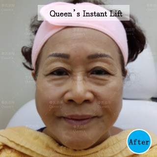 Instant-Lift-After-Aunty-Helen Instant-Lift-After-Aunty-Helen