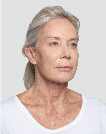 After-Silhouette-Soft-Lift-to-Neck After-Silhouette-Soft-Lift-to-Neck