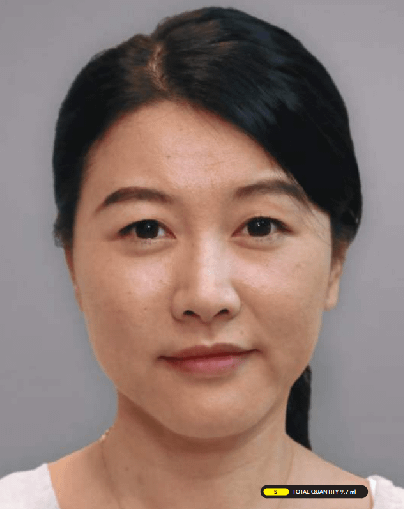 Asian-After-Ellanse-Treatment Asian-After-Ellanse-Treatment