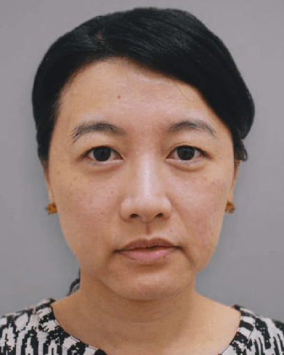 Asian-Before-Ellanse-Treatment Asian-Before-Ellanse-Treatment