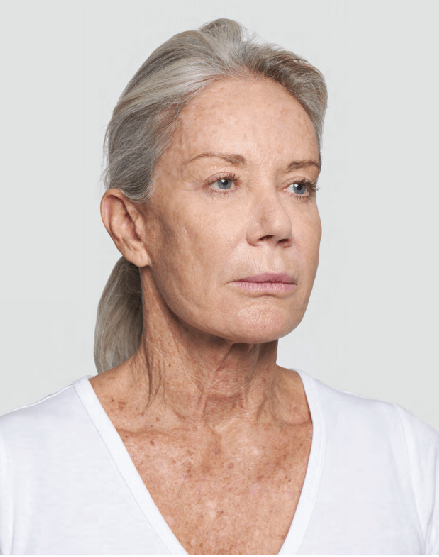 Before-Silhouette-Soft-Lift-to-Neck Before-Silhouette-Soft-Lift-to-Neck