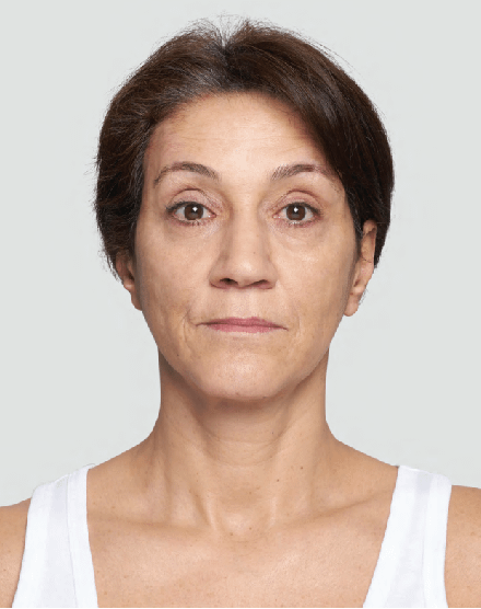 Browlift-with-Silhouette-Soft-After Browlift-with-Silhouette-Soft-After