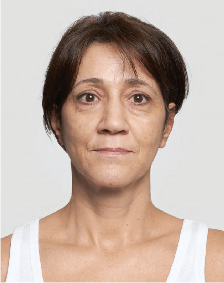 Browlift-with-Silhouette-Soft-Before Browlift-with-Silhouette-Soft-Before