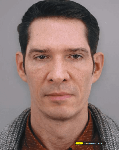Male-Sample-After-Ellanse Male-Sample-After-Ellanse