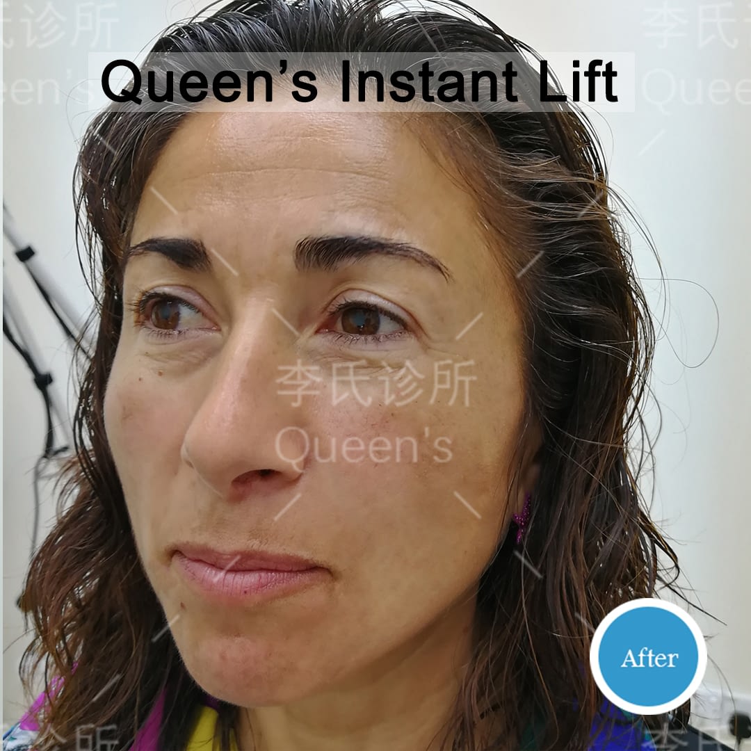 Rita-Pisu-After-Instant-Lift-Treatment Rita-Pisu-After-Instant-Lift-Treatment