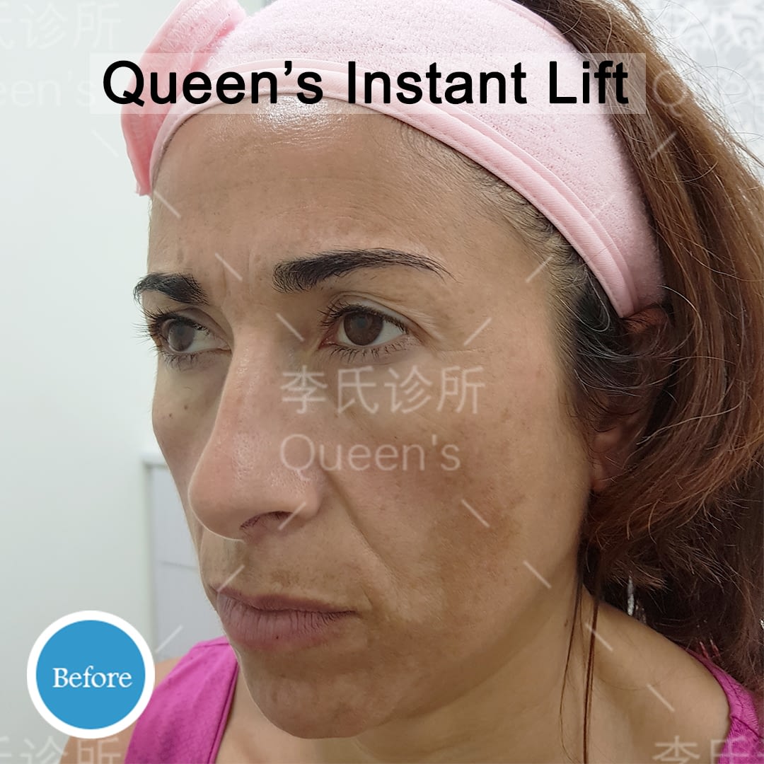 Rita-Pisu-Before-Instant-Lift-Treatment Rita-Pisu-Before-Instant-Lift-Treatment